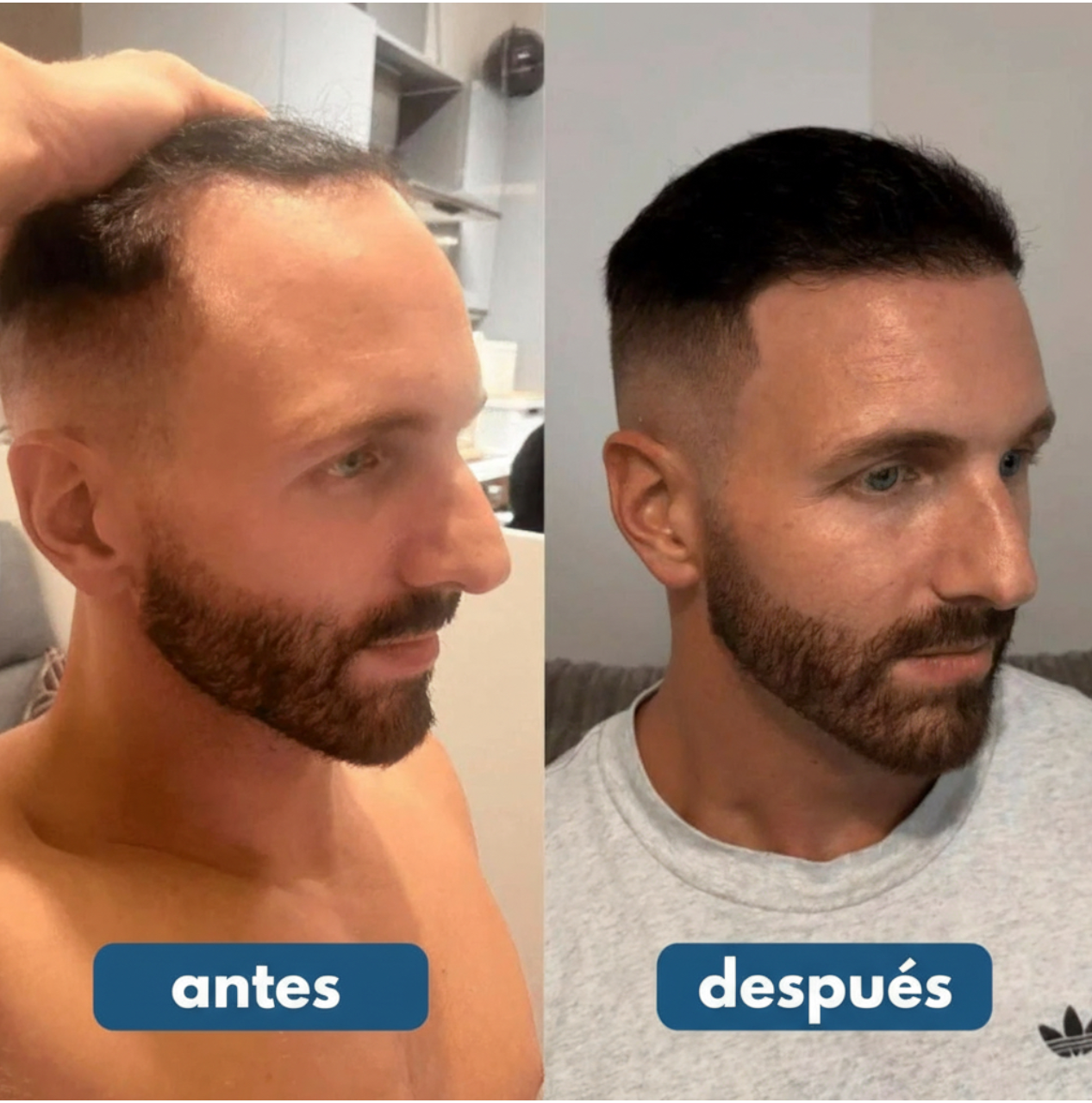 Roll-On de Crecimiento Capilar™